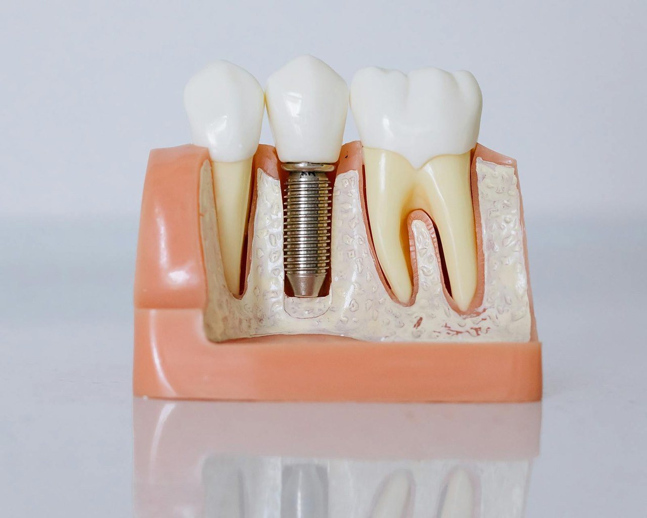 Cross-section model of a dental implant — a titanium post and crown replacing a missing tooth