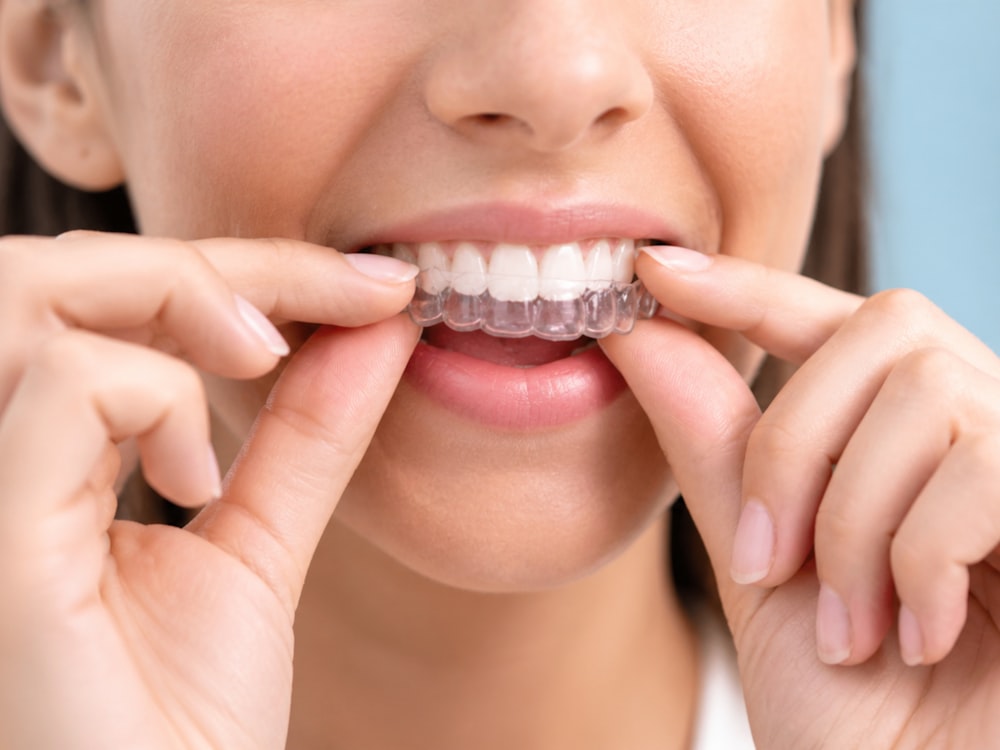 Patient placing a clear Invisalign aligner